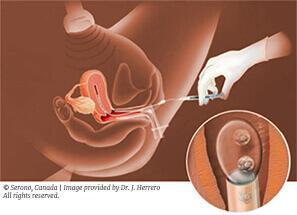 IVF procedure for women over 60